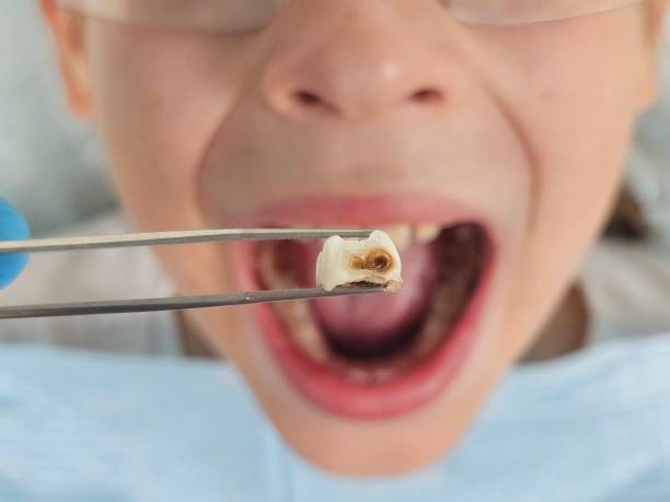 Best Emergency Dental Extractions in Navy Yard City, WA